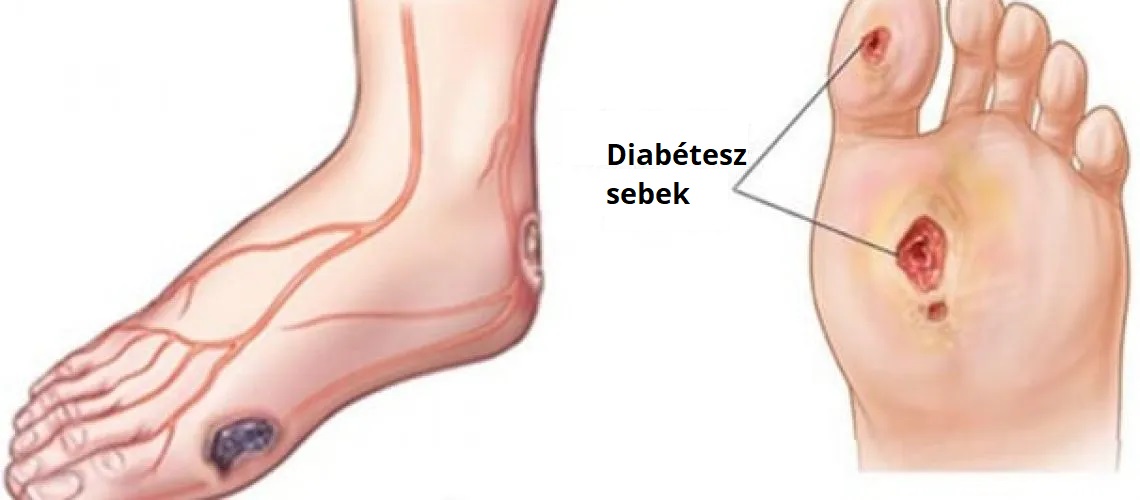 Cukorbeteg láb kezelése otthon