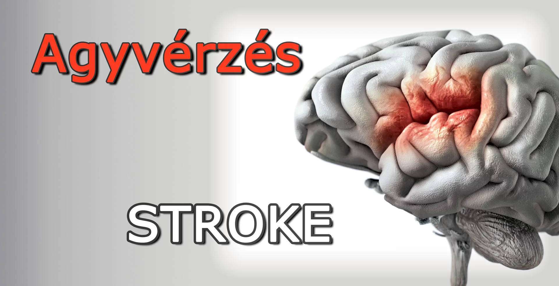 agyvérzés-stroke